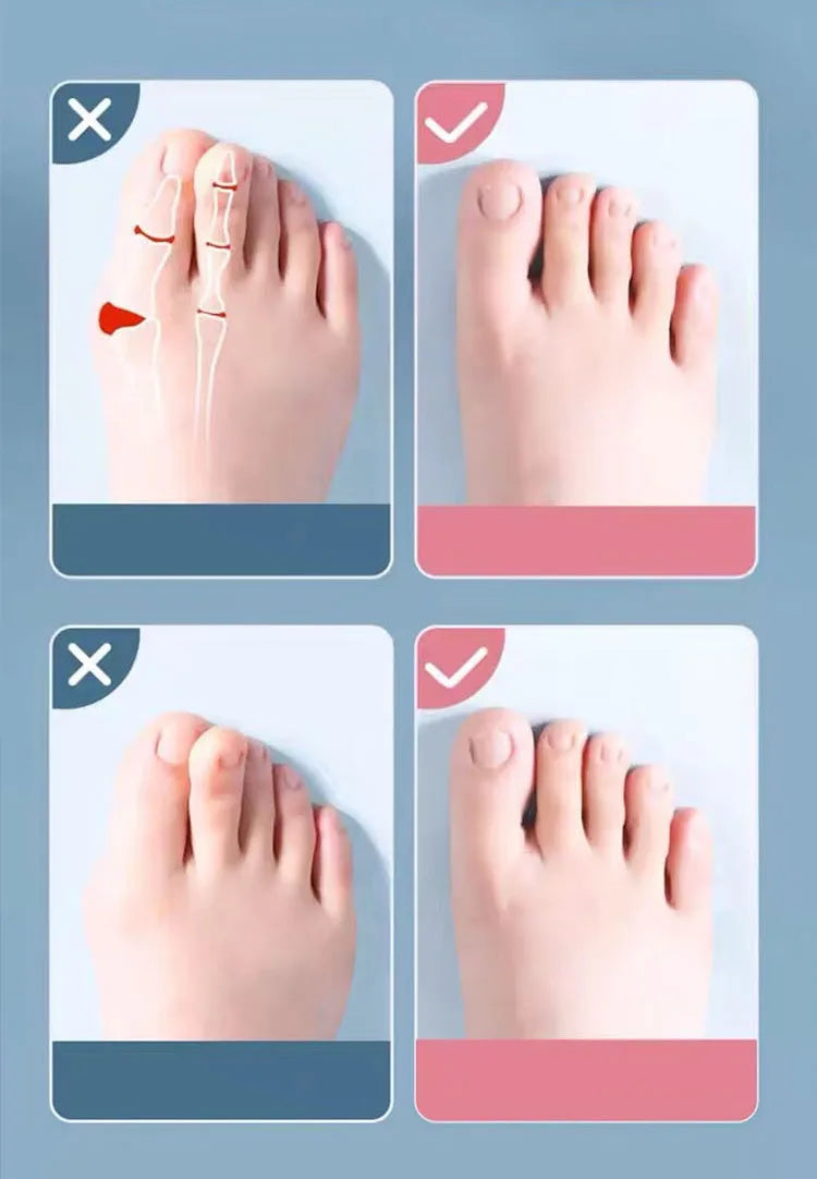 2Pc Silicone Toe Separator Fingers Feet Toe Spreader Hallux Valgus Bunion Corrector Toe Straightener Corrector Finger Separators